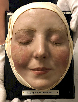 Lotte Luise Volger, Lupus erythematodes, undatiert, Moulagenmuseum des Universitätsspitals und der Universität Zürich, © Moulagenmuseum USZ/UZH